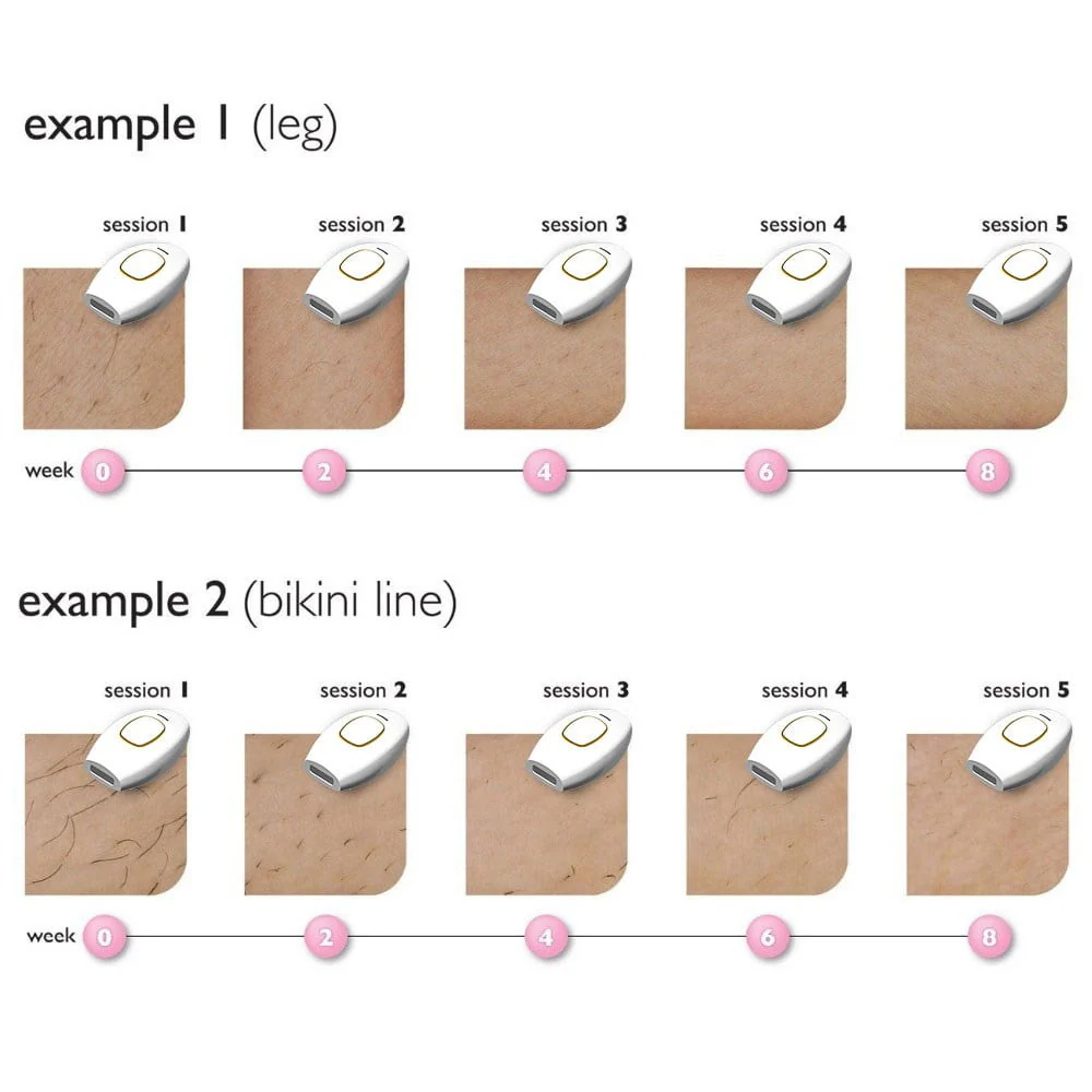 IPL Laser Hair Removal - Image 10